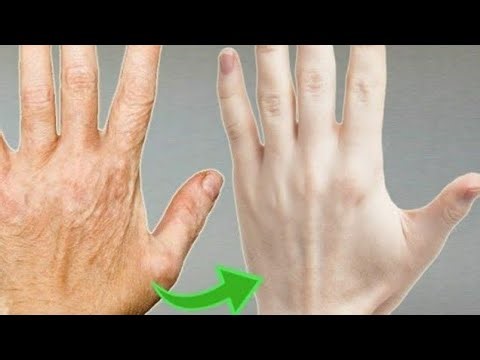 How to Remove Wrinkles from Hands Naturally | Hand Wrinkle Treatment at Home