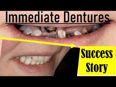 Immediate Dentures! A Success Story.