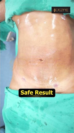 Abdomen Liposuction | Abdomen Liposuction Result