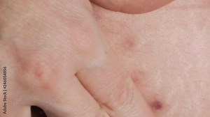 Woman showing the stomach with a appendicitis scar after surgery. Scar removal