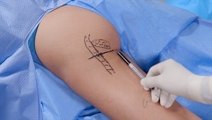 Combined Endoscopic and Open Repair of a Chronic Hamstring Tear