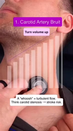 @doctor.hoon.bhai on Instagram: "Different Sounds of Different Blood Vessels — What Your Stethoscope Can Really Hear ✨🩺 Every blood vessel has a story — and sometimes, it speaks through subtle sounds that reveal what’s happening inside the body. While normal arteries and veins remain silent, altered blood flow can create unique acoustic signatures that guide clinicians toward the right diagnosis. 🔸 Arterial Bruits When blood rushes through a narrowed artery, it becomes turbulent — producing a 