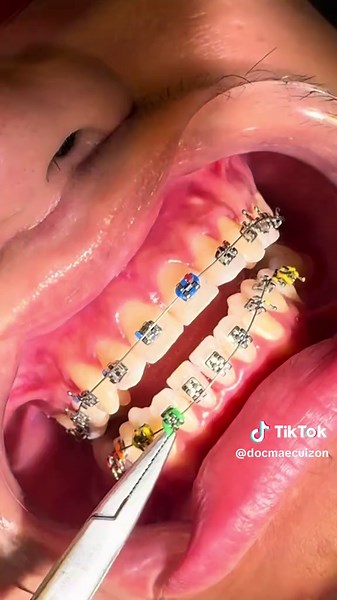 Rainbow Dental Braces: A Colorful Smile Transformation