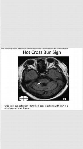 Hot cross bun sign #radiology #neurology #inicet #neetpg