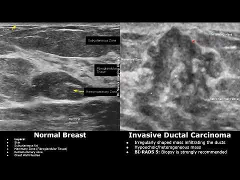 Breast Ultrasound Normal Vs Invasive Ductal Carcinoma (IDC) | BI-RADS 4/5 Masses | Breast Cancer USG