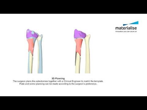 Distal Radius Malunion | Patient-Specific Guides for Radial and Ulnar Osteotomy