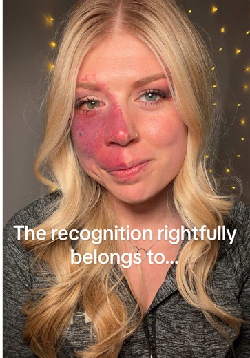 Empowering Makeup Artistry for Birthmark Visibility