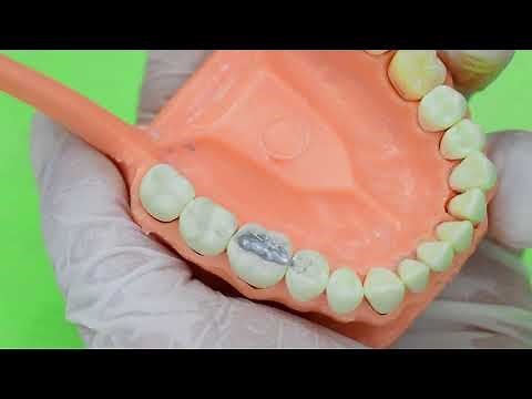 ¿Cómo poner una Amalgama Dental?