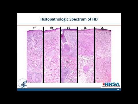 When to Suspect Leprosy: Clinical Aspects and Treatment of Uncomplicated Hansen's Disease