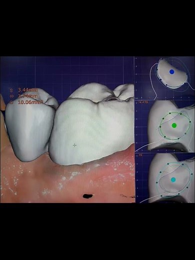3-Unit Bridge Design (Inlay, Pontic & Anatomic Crown)