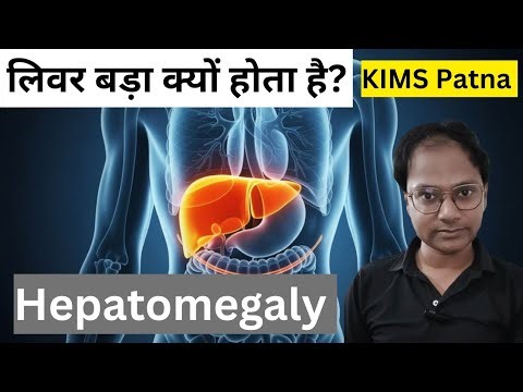Liver Enlargement (Hepatomegaly) Full Details | Causes | Symptoms | Sandeep Sir Patna | KIMS Patna