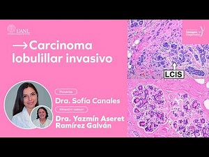 Carcinoma lobulillar invasivo por la Dra. Sofía Canales.