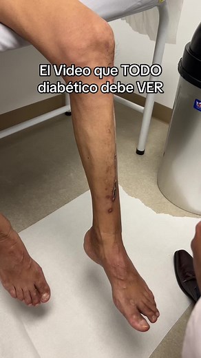 Cascada de daño en el Pie Diabético: Explicación Completa