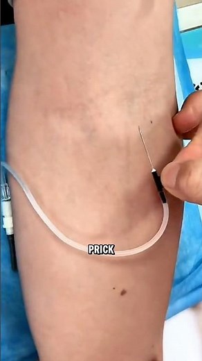 Mastering the Flying Needle Technique