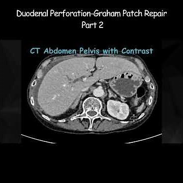 Duodenal Perforation Graham Patch Repair Part 2 #infertility #pepticulcer #radiology #radiologist
