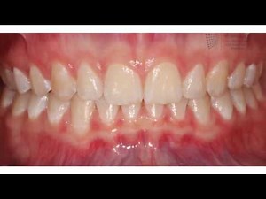 Straightening your teeth with Invisalign
