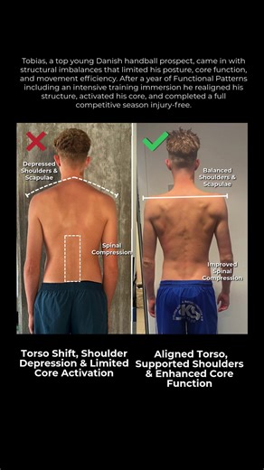 Functional Patterns Evidence Based Practice on Instagram: "Structural Imbalances to Athletic Longevity In August 2024, Tobias—one of Denmark’s top young handball prospects—began training Functional Patterns to enhance his career longevity and reduce injury risk. After a year of consistent online work and an intensive in-person training immersion, his structure transformed with improved posture, abdominal activation, and spinal alignment, allowing him to finish the season without injury. Before (