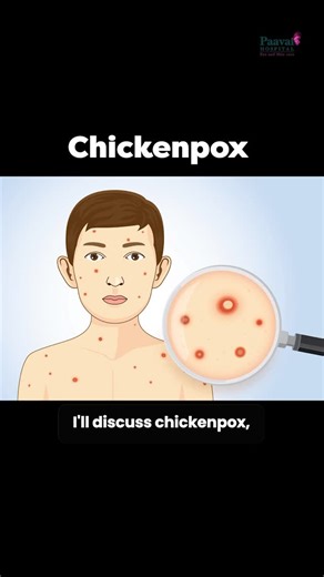 Dr.Paavai senthil | Faith heals the mind. But Medicine heals the virus. 🦠🙏 We often call Chickenpox Ammai and treat it with fear and devotion. But medically,... | Instagram