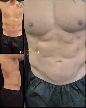 Liposculpture 360 and Ab Etching on Men at Tampa Surgical Arts