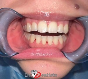 Invisible Aligners (Orthodontic Treatment) Case. De Dentiste offers...