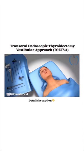 medical_animation | Transoral Endoscopic Thyroidectomy Vestibular Approach (TOETVA) is a minimally invasive, scarless thyroid surgery performed through small... | Instagram