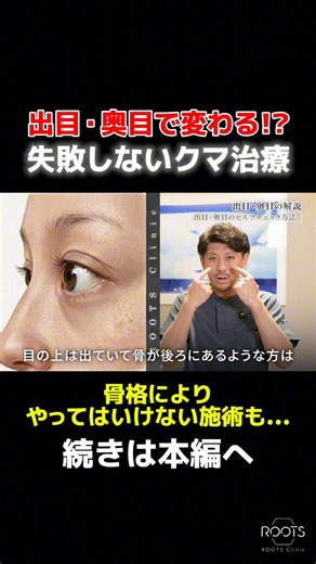 【出目・奥目で治療内容が変わる！骨格からクマ治療を解説します】#クマ取り #クマ治療 #目の下のクマ #裏ハムラ #rootsclinic
