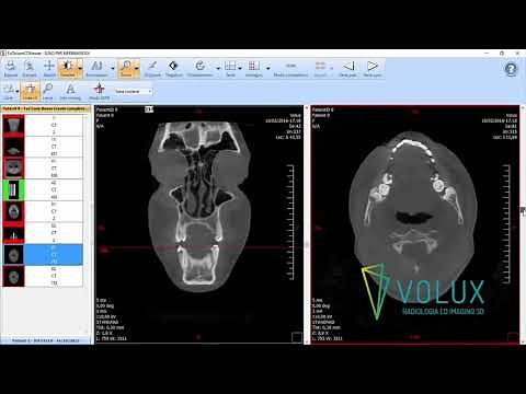 Volux - Tutorial EZ-Dicom Viewer
