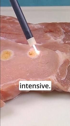 APC stands for Argon Plasma Coagulation #Science #medtech #medicine #education