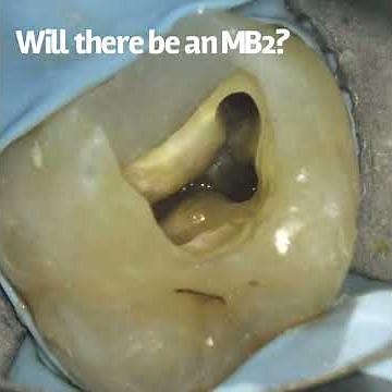 The root to success – tips for locating and treating the MB2
