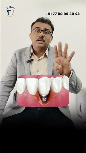 Dental Implants | Are They REALLY Safe? Complications You NEED to Know