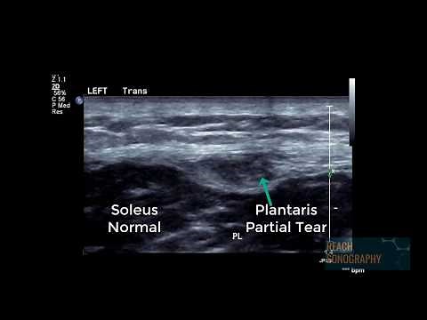 Normal and abnormal plantaris tendon of the calf