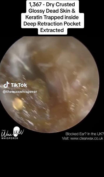 Keratin Impaction Removal from Deep Ear Pocket | The Wax Whisperer