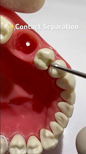 “Separation of the contact area” | Dr.Dentique-hub