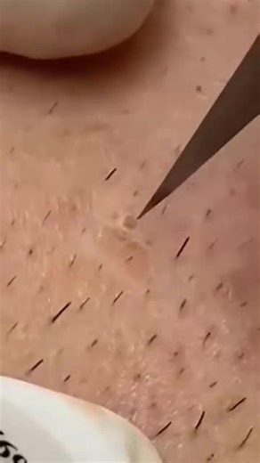 Effective Blackheads Removal Techniques at Spa Skin Care