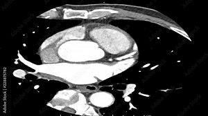 Coronary CT Angiography , computed tomography angiography ( CTA ) coronary angiogram ,Axial view speed run.