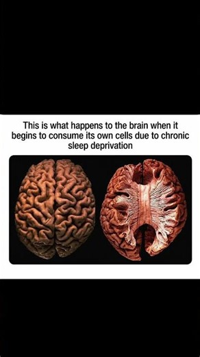 Skipping Sleep Is Causing Your Brain to Eat Itself...😳