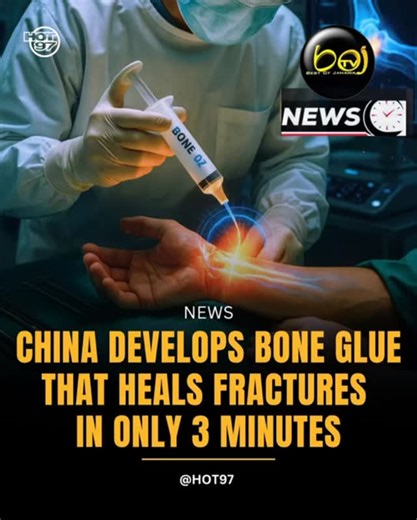 #News According to Global Times, scientists in China have created a breakthrough “bone glue” capable of repairing fractures within minutes. The product, called Bone-02, was designed to treat orthopedic injuries that usually take months to heal and often require invasive surgeries with metal plates. Lin Xianfeng, associate chief orthopedic surgeon at Sir Run Run Shaw Hospital in Hangzhou, explained that the adhesive works in just minutes, even in blood-rich areas. The treatment is delivered throu