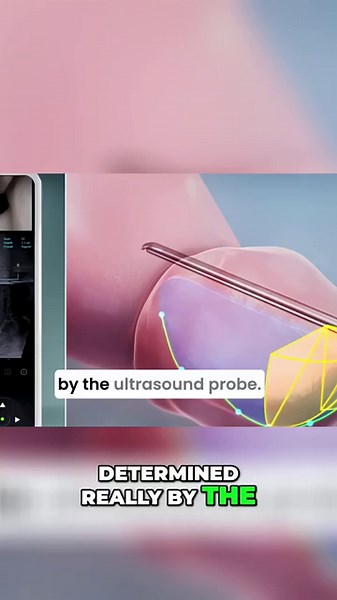 Doctor Explains Prostate Treatment Planning: Volume Study & Precision!