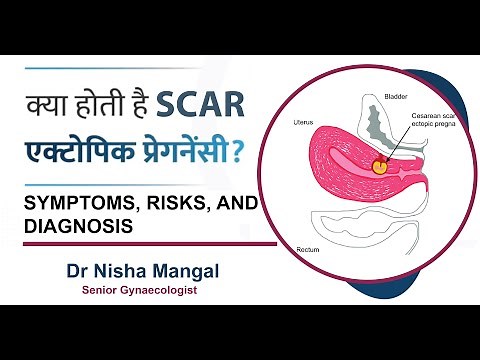 Scar Ectopic Pregnancy Explained: Symptoms, Risks, and Diagnosis | Dr. Nisha Mangal | Expert Insight