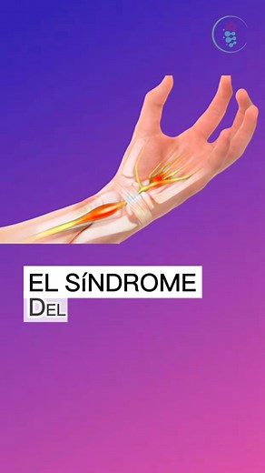 🔎 Prueba de Phalen: Evaluando el síndrome del túnel del carpo 📏✋Mantén las muñecas en flexión durante 60 segundos y observa si hay hormigueo o dolor en los dedos. ¡Una herramienta sencilla pero efectiva en la evaluación neurológica! #Fisioterapia #EvaluaciónClínica #tuneldelcarpo #carpo #mano #lesiones #dolor | Rehabilitación Segura