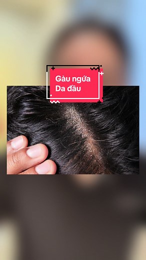 Gàu: Tín hiệu cần chăm sóc da đầu đúng cách