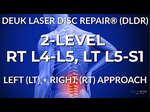 LUMBAR HERNIATED DISCS L4-L5, L5-S1 - LIVE - Laser Spine Surgery