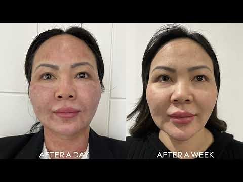Skin Resurfacing Treatments using iPixel by Harmony