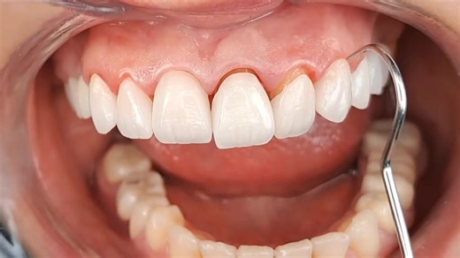 The Benefits of Zirconia Crowns for Lasting Dental Restorations