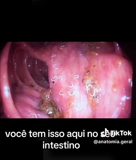 Taenia Solium: O Parasita Intestinal que Afeta Milhões de Pessoas