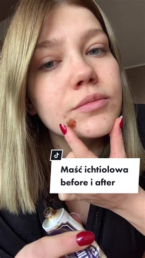Maść ichtiolowa i pasta z kalaminą: skuteczne terapie
