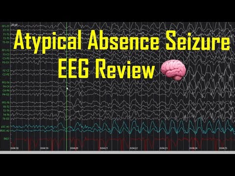 Atypical Absence Seizure EEG Review