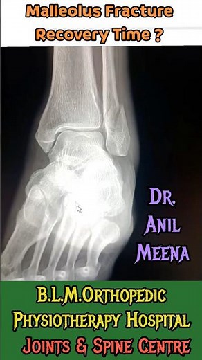 ankle Fracture Recovery Time | Lateral Malleolus fracture recovery time | Malleolus fracture
