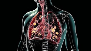 Lungs affected by cystic fibrosis, a genetic disorder causing thick mucus production. 3D animation shows bronchi dilation due to mucus accumulation and inflammation.