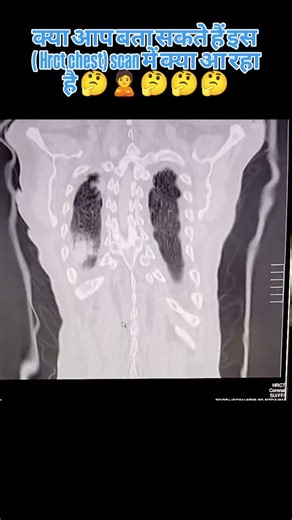Hrct chest what is diagnosis 🧑‍⚕️ 🧑‍⚕️ 🧑‍⚕️ 🧑‍⚕️ #mri #anatomy #grossanatomy what's happened